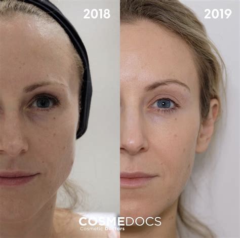 Botox Brow Lift Before And After Everything You Need To Know Our eyebrows are an integral part of our facial expressions. . Botox brow lift before and after reddit